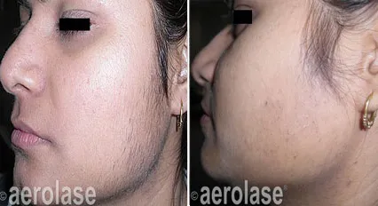 Aerolase before and after example for laser hair removal
