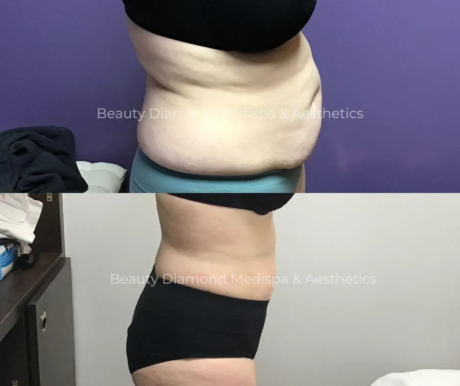 Body contouring before and after side view result from Beauty Diamond gallery