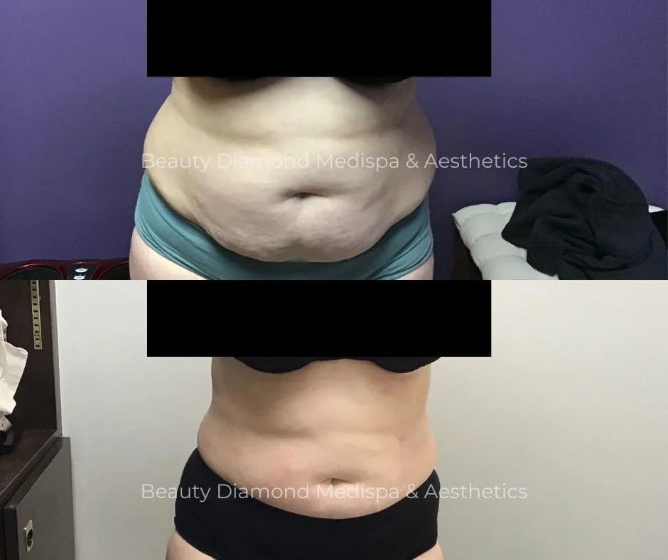Body contouring before and after front view result from Beauty Diamond gallery