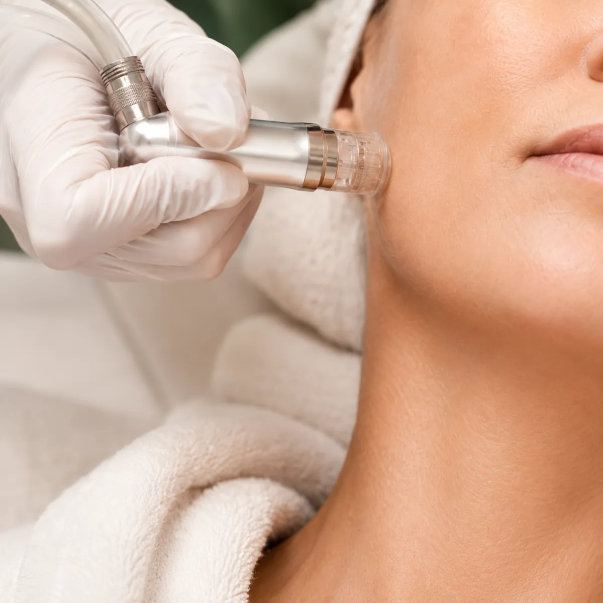 Microdermabrasion