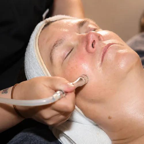 Microdermabrasion