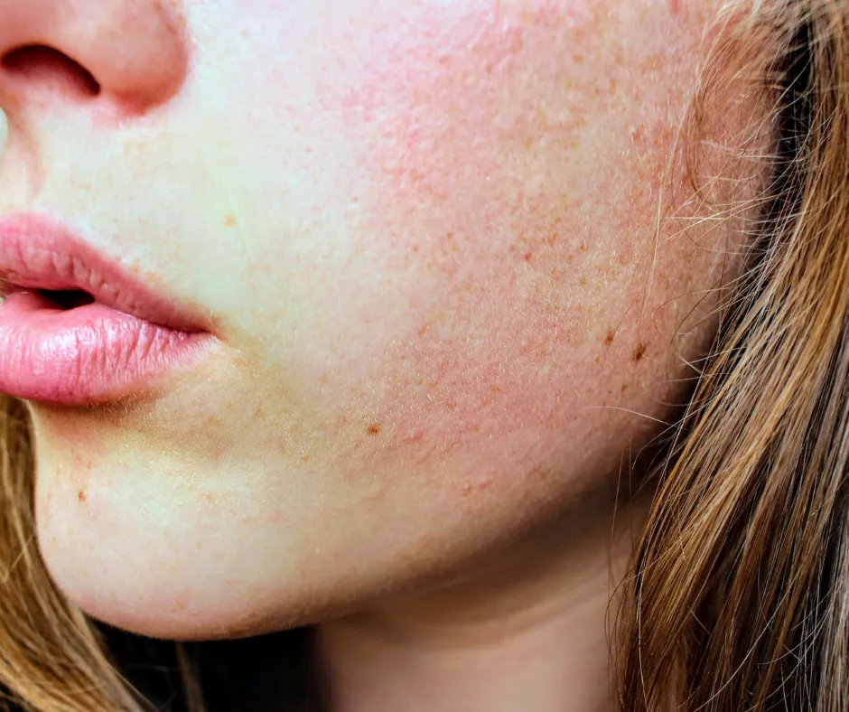 Close-up of dry, sensitive skin showing signs of tightness and flaking, used for clinical skin type identification by JuJubee Skincare.