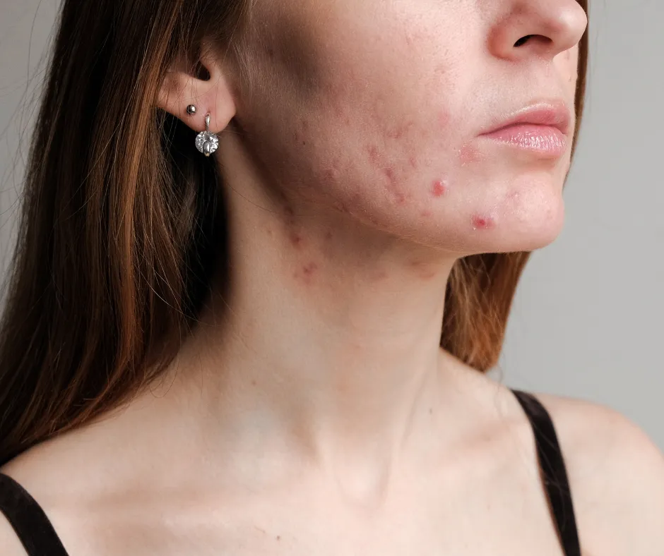 Example of oily and acne-prone skin with visible congestion and shine, highlighting professional skincare needs for oil control.