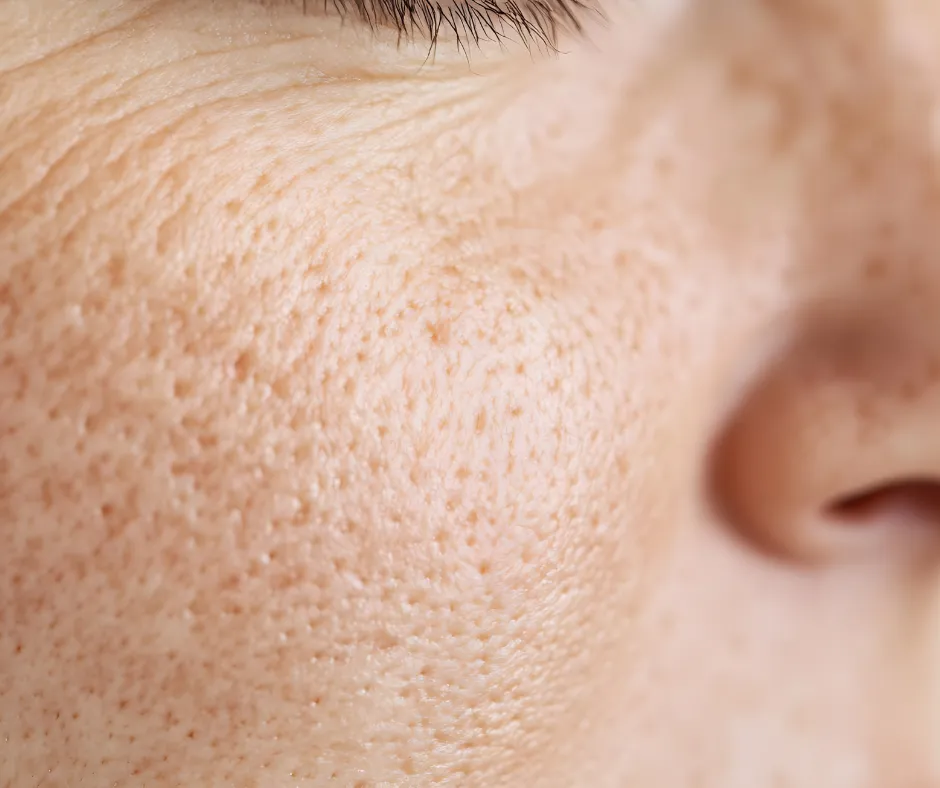 Clinical representation of skin redness and dehydration concerns, focusing on fine lines and texture improvement through expert guidance.