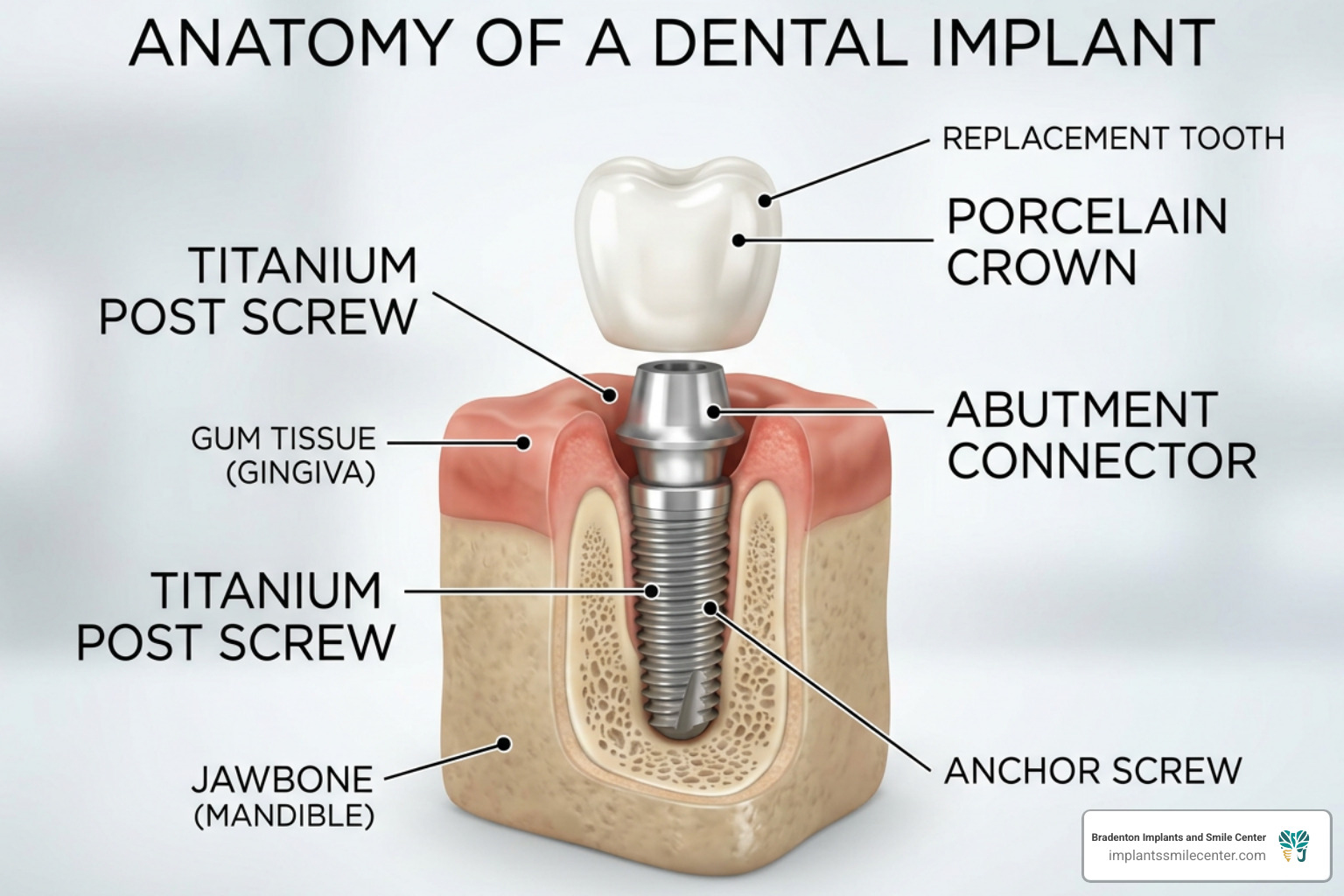 Diagram showing the three parts of a dental implant: titanium post, abutment, and porcelain crown - senior dental implants