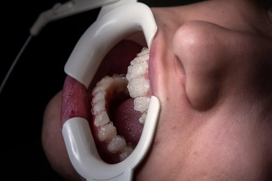 full mouth implants