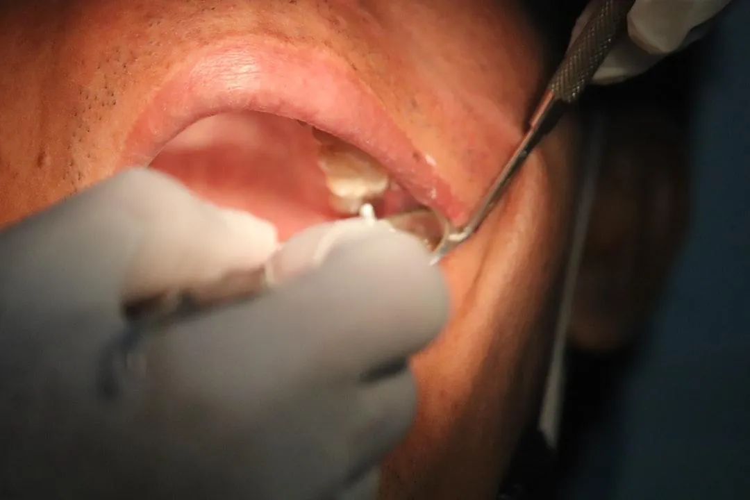 permanent teeth implants