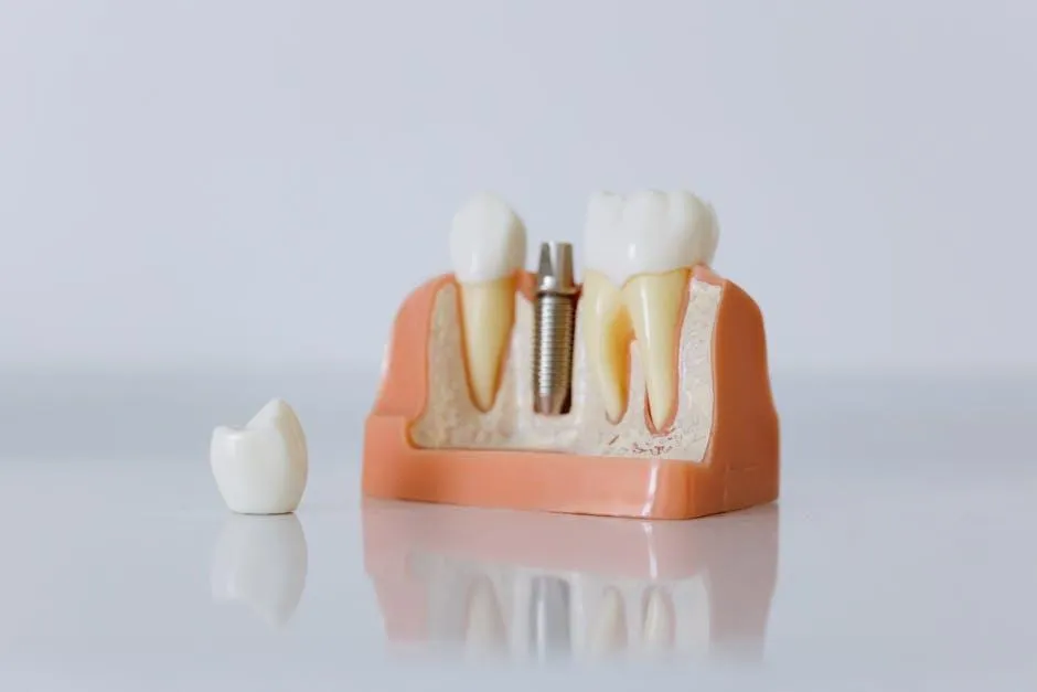 dental implants bradenton florida