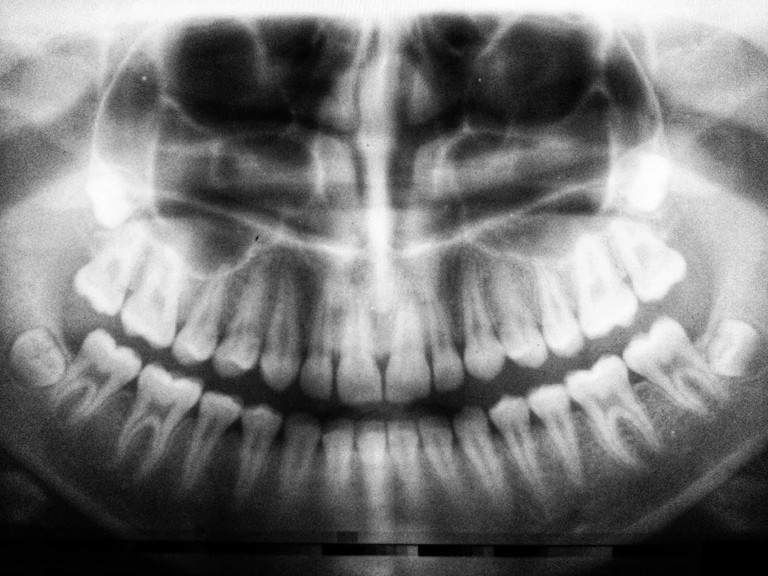 fast wisdom teeth recovery