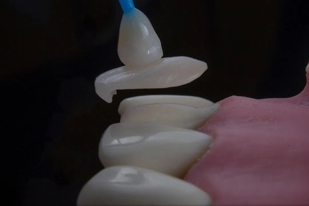 immediate implant placement