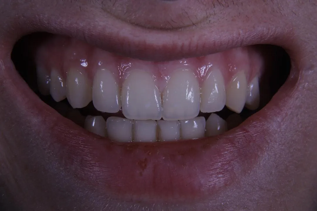 dental implants before and after smile transformation