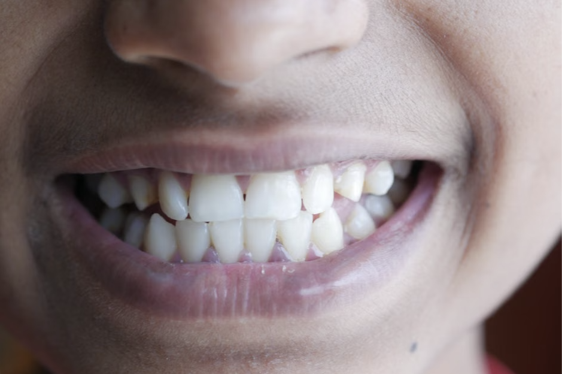 full mouth cosmetic dentistry patient smiling confidently after dental transformation