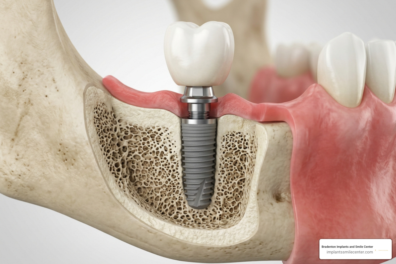 Anatomical diagram of dental implant post abutment and crown