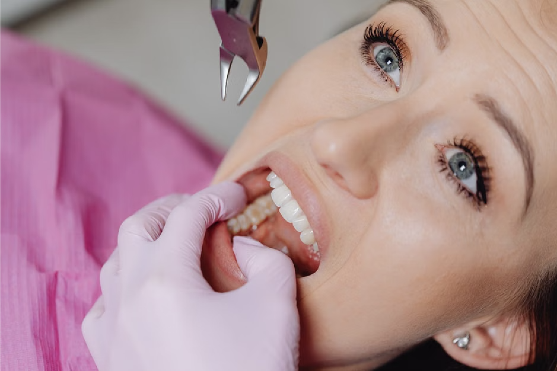 wisdom teeth extraction