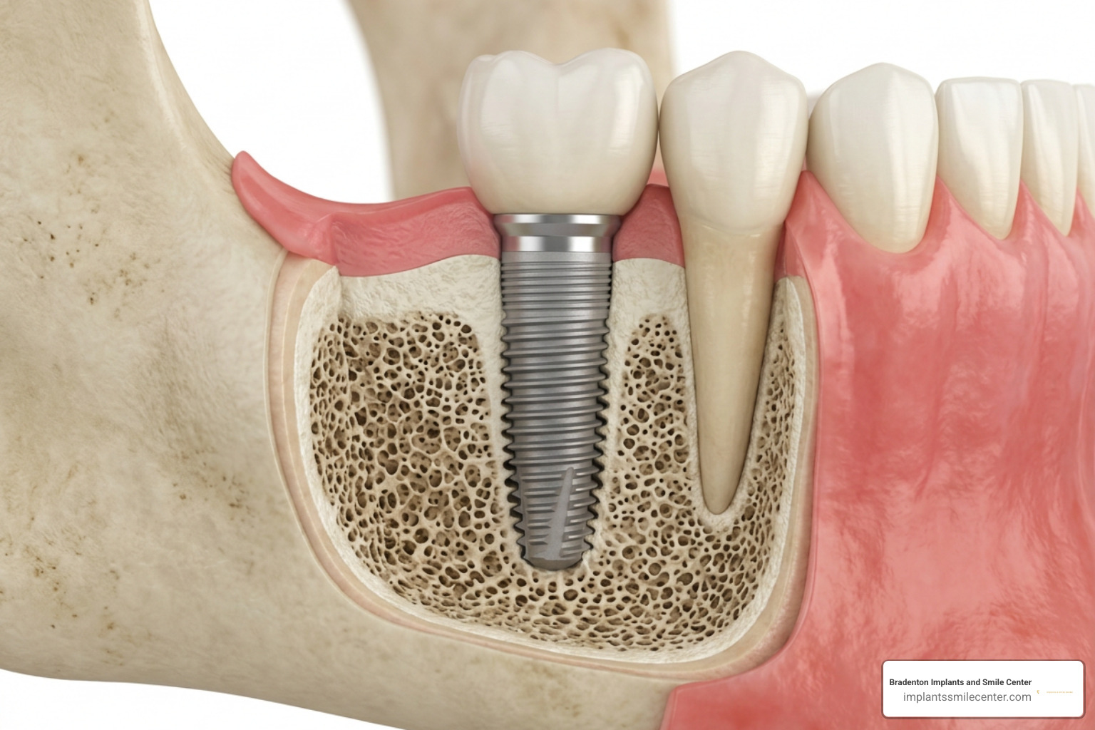 Permanent Full Mouth Teeth: Exploring Your Restoration Options