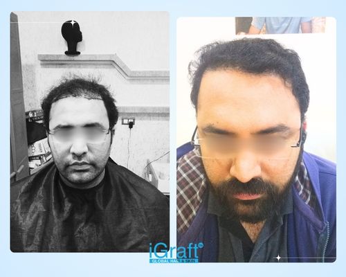 Best crown hair transplant treatment for bald spot with natural hair growth and permanent results