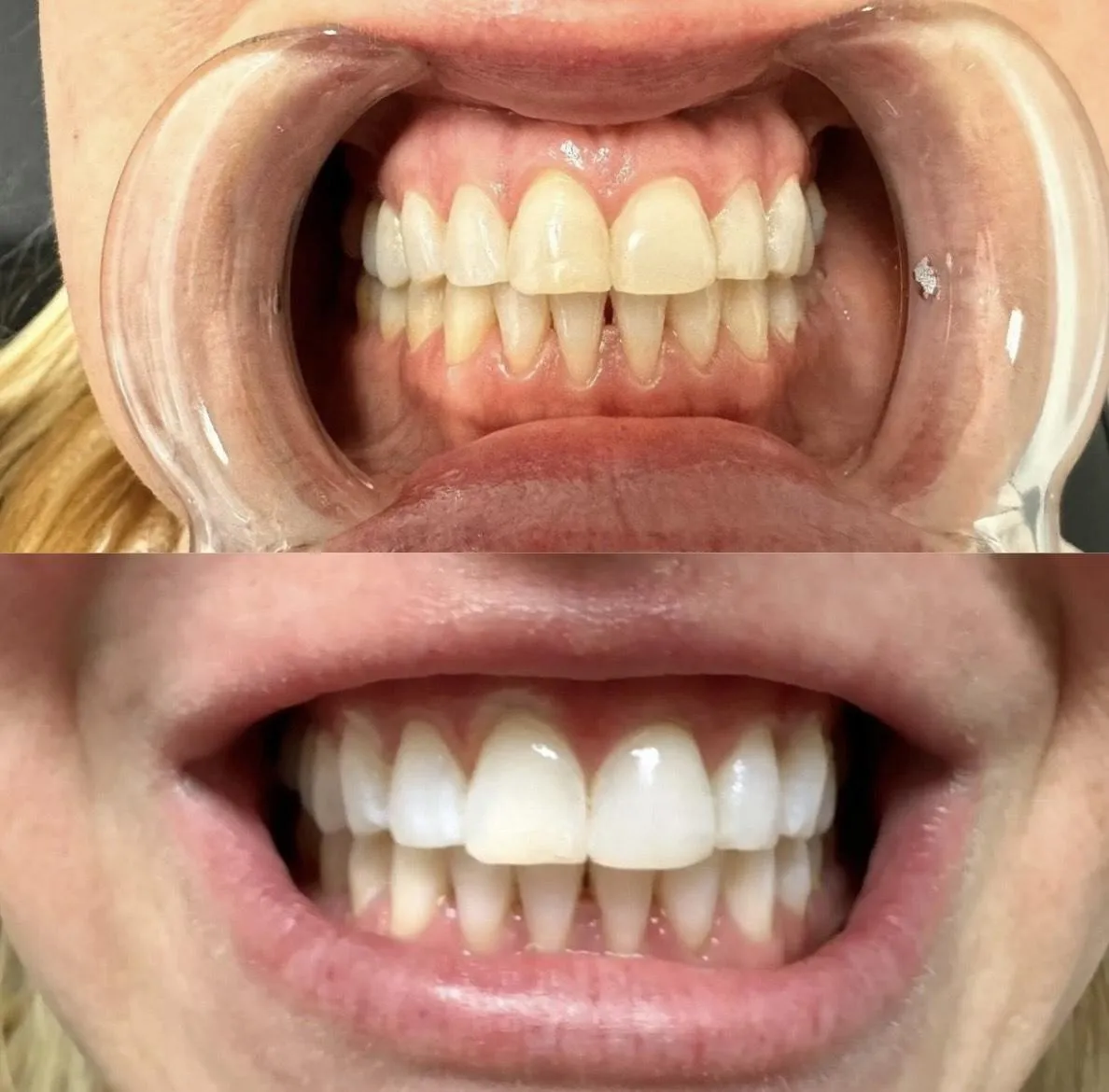 Teeth Whitening 