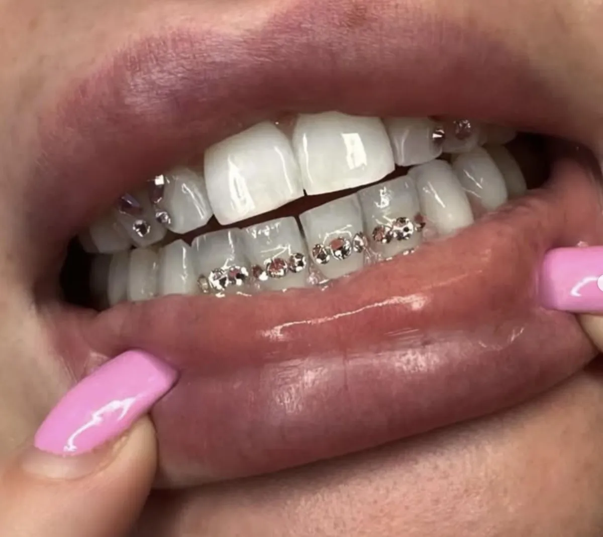 Tooth gem