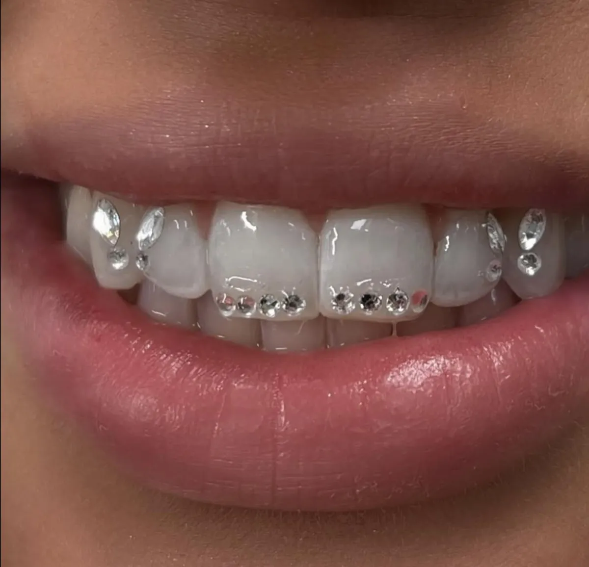Teeth Whitening near me