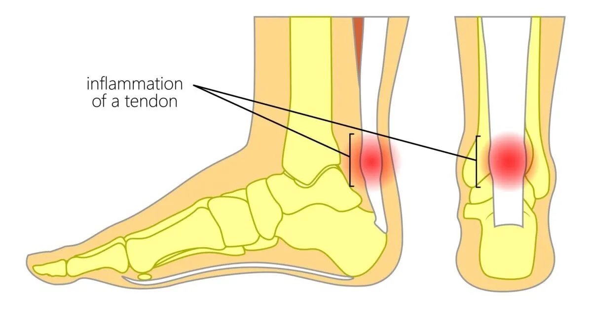 Achilles Tendonitis in Runners: Top Prevention and Treatment Tips