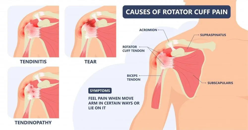 Navigating the Path to Physical Fortitude: Understanding Gym-Induced Injuries