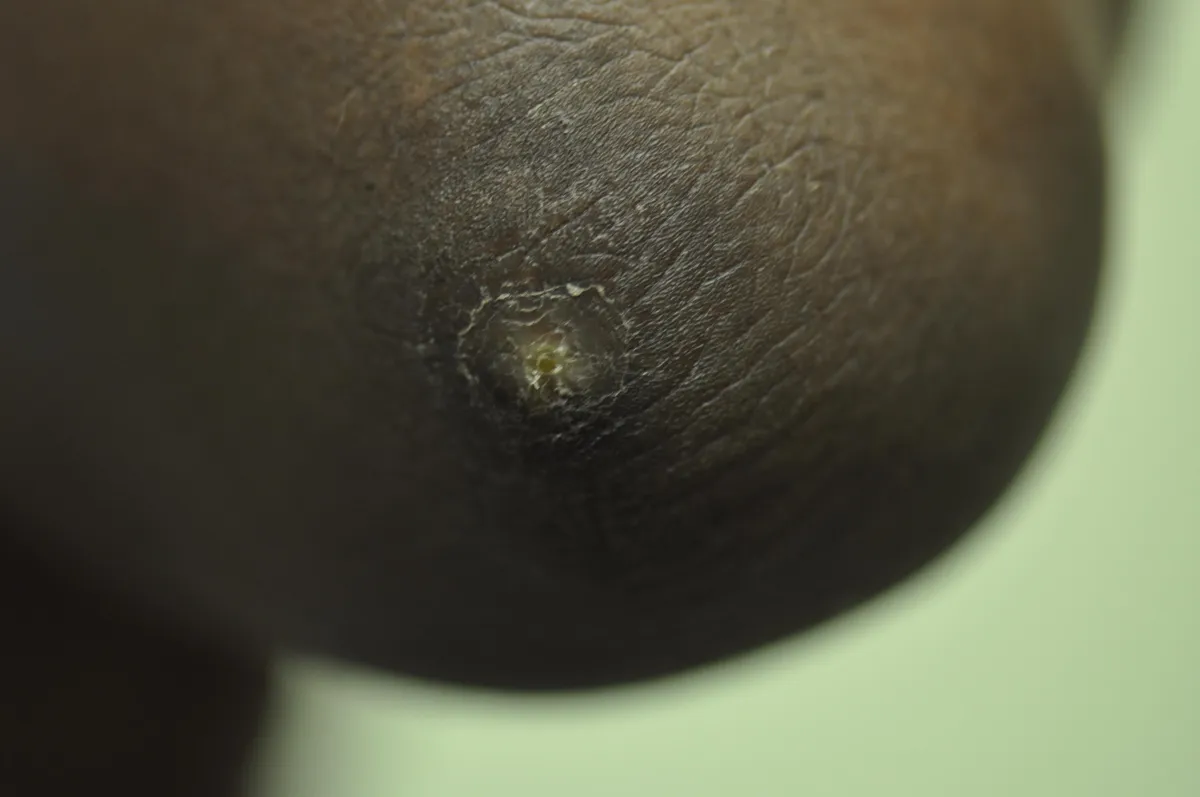 SCLERODERMA