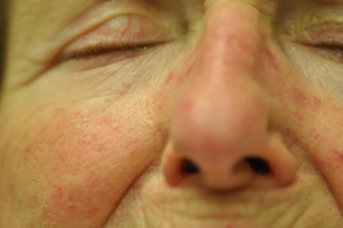 SCLERODERMA