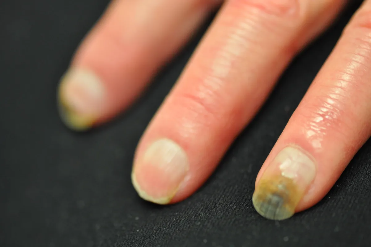 SCLERODERMA