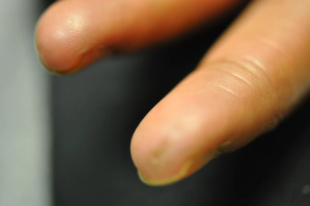 SCLERODERMA