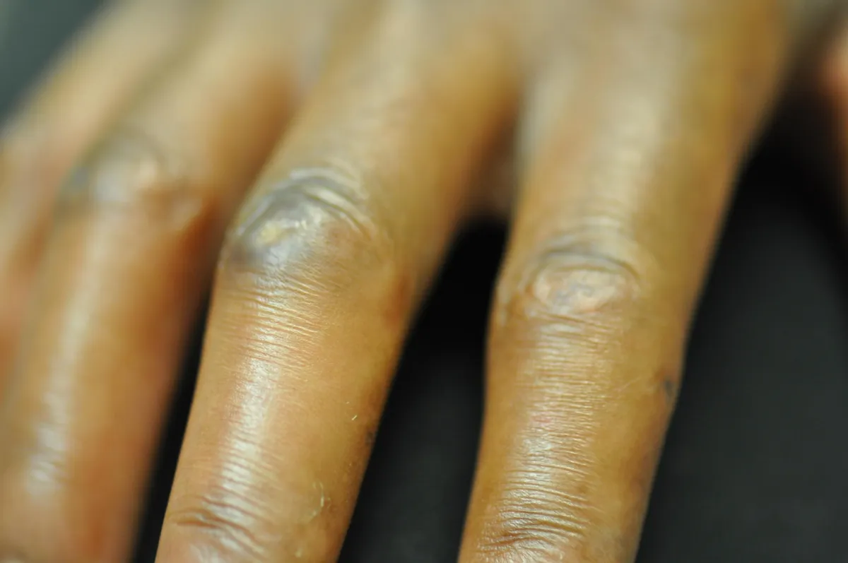 SCLERODERMA