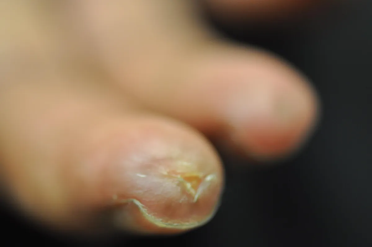 SCLERODERMA