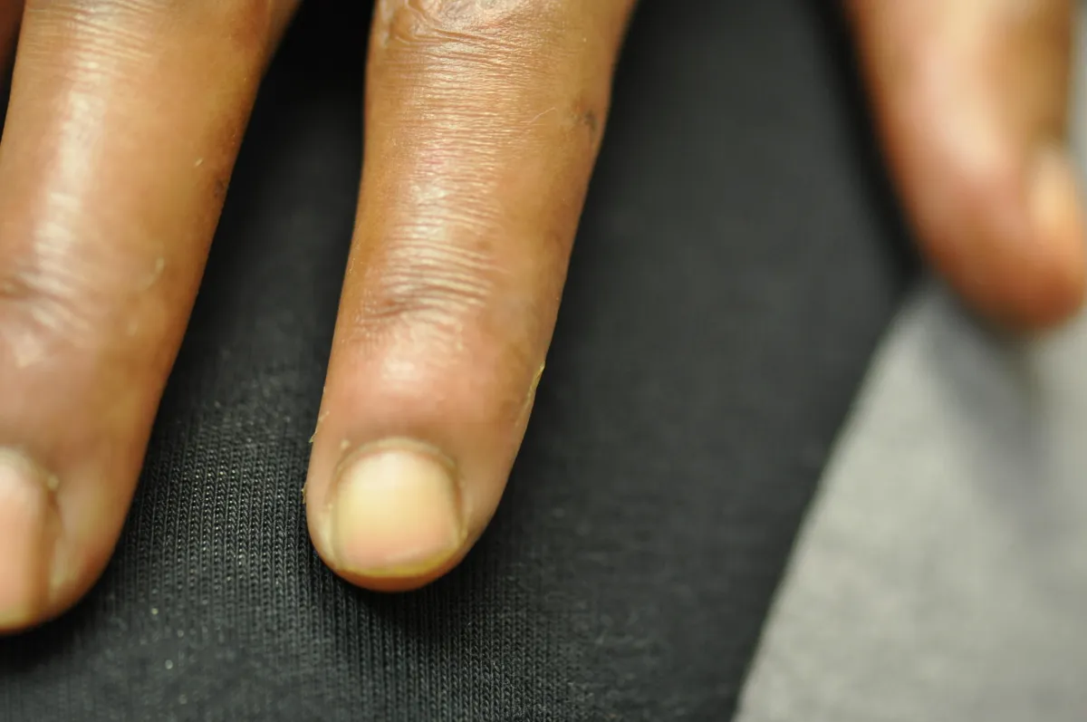 SCLERODERMA