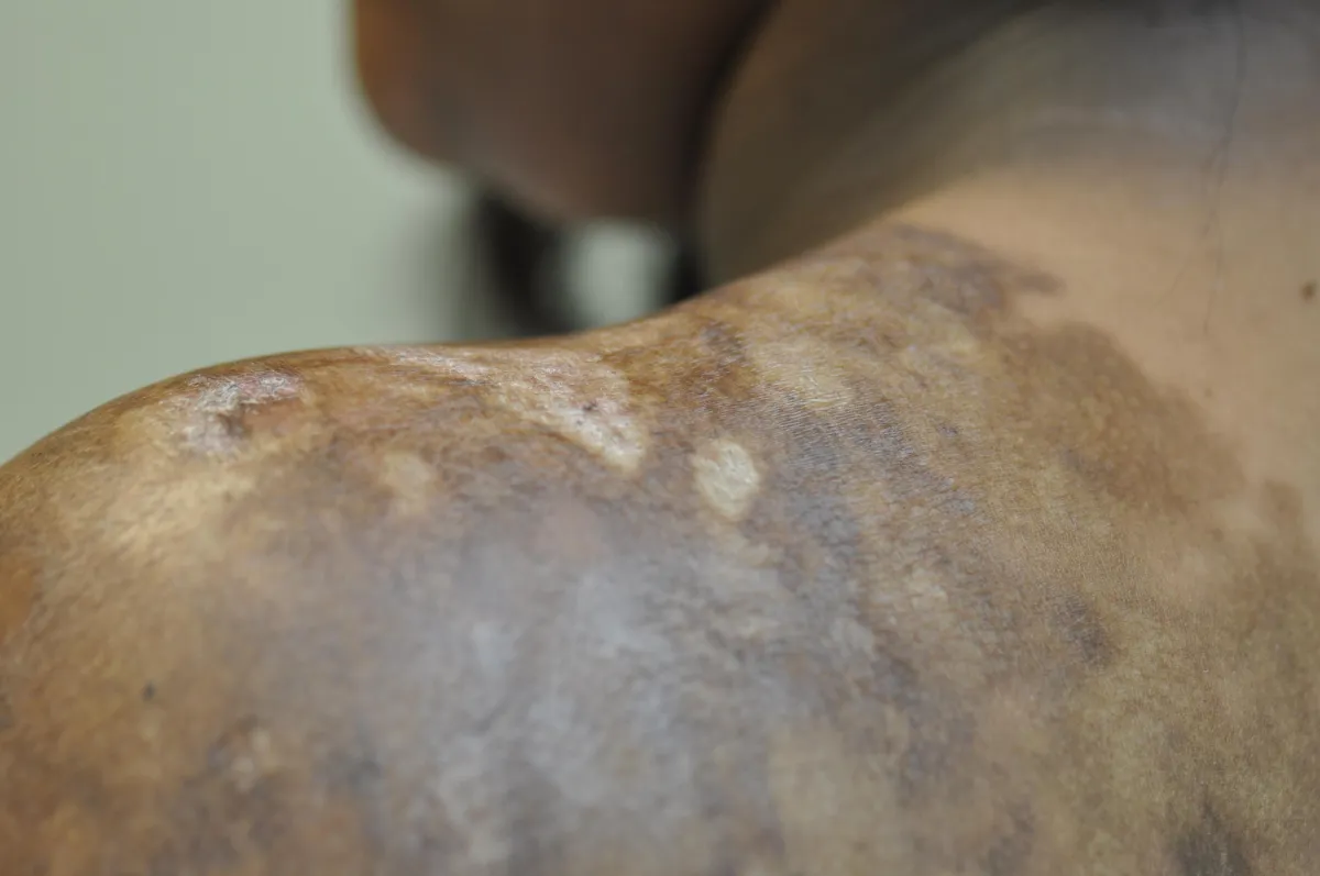 SCLERODERMA