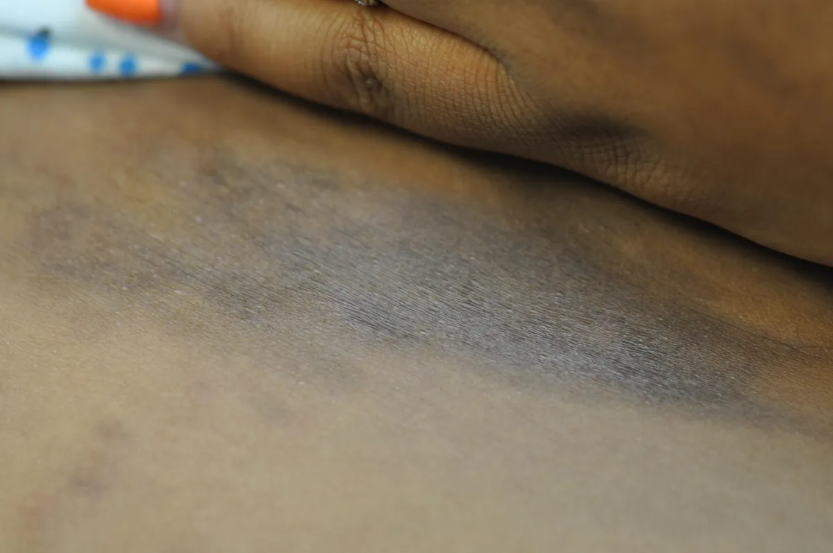 SCLERODERMA