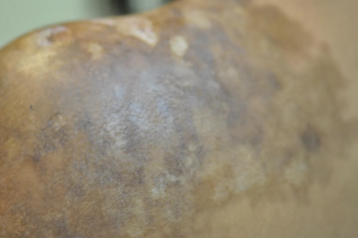 SCLERODERMA