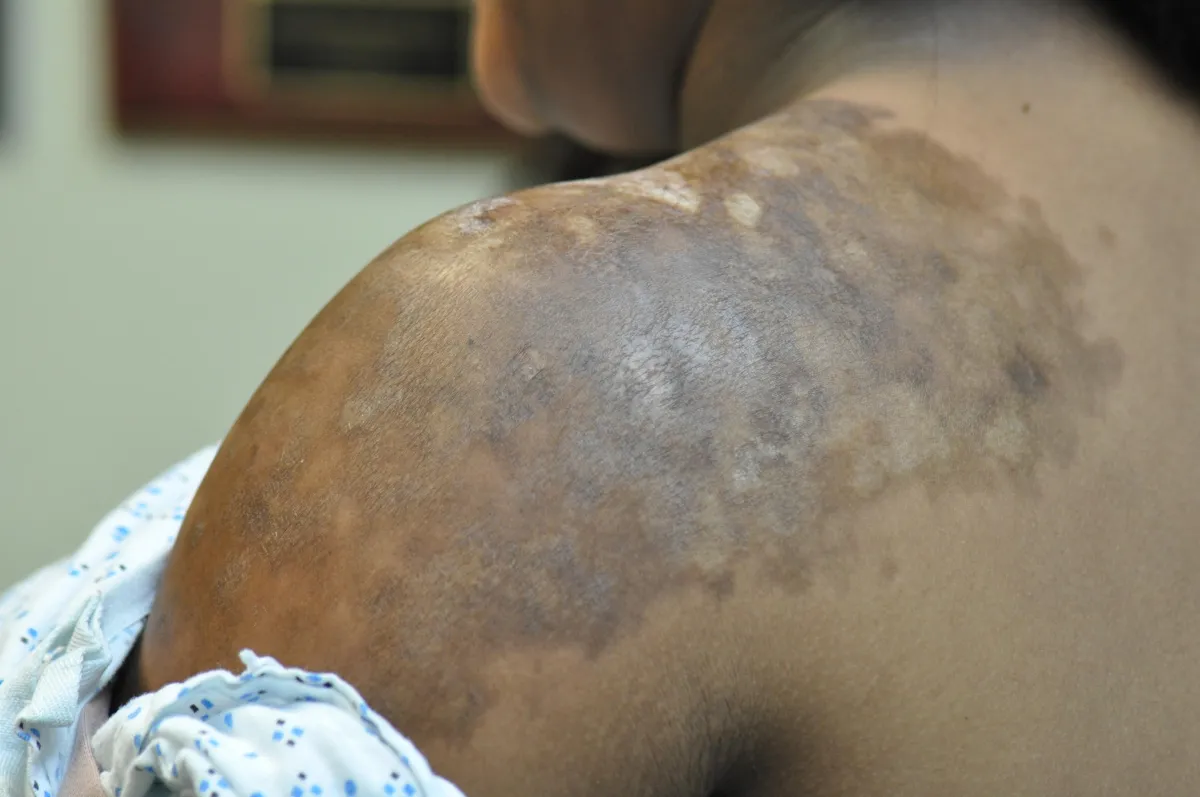 SCLERODERMA