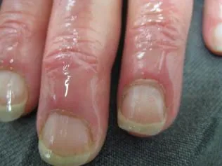 SCLERODERMA