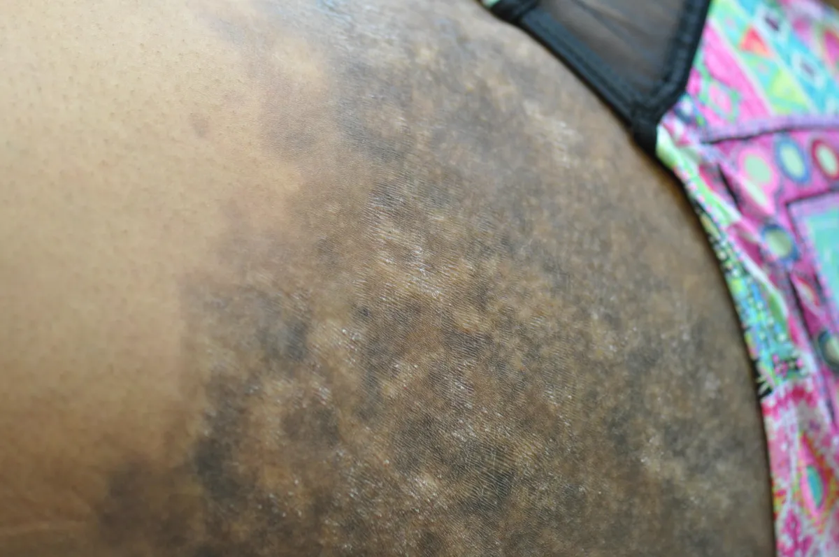 SCLERODERMA