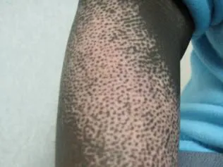 SCLERODERMA