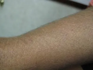 SCLERODERMA