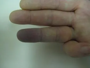 SCLERODERMA
