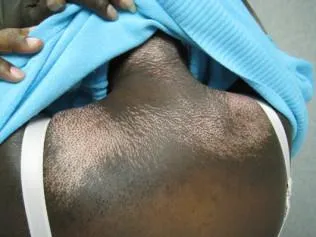 SCLERODERMA