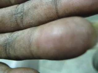 SCLERODERMA
