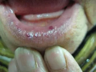SCLERODERMA
