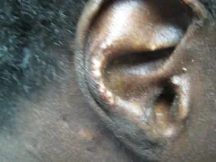 SCLERODERMA