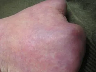 SCLERODERMA