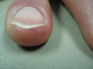 SCLERODERMA