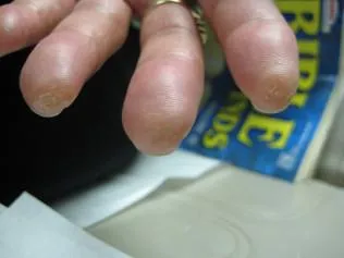 SCLERODERMA
