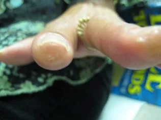 SCLERODERMA