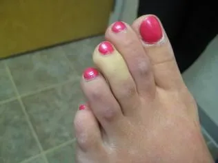 SCLERODERMA